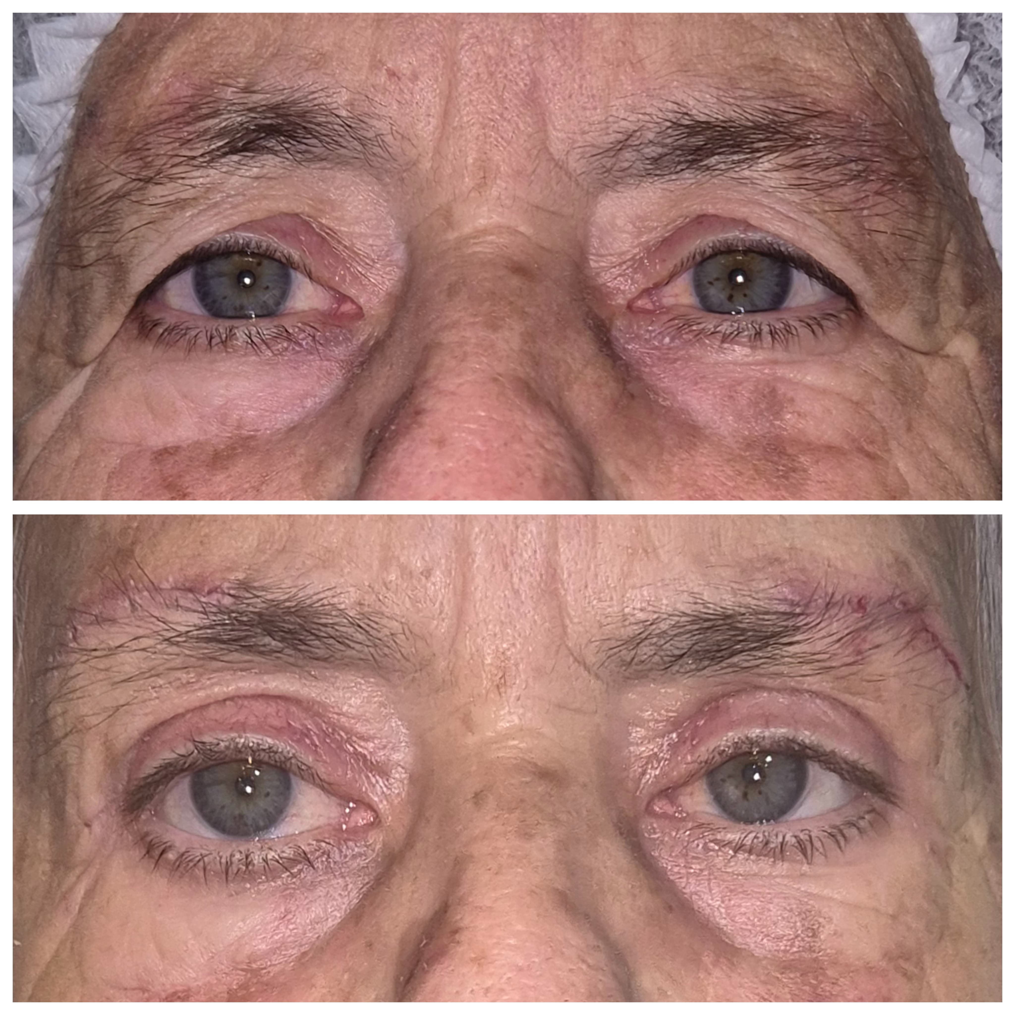 Foto ilustrativa da blefaroplastia 3